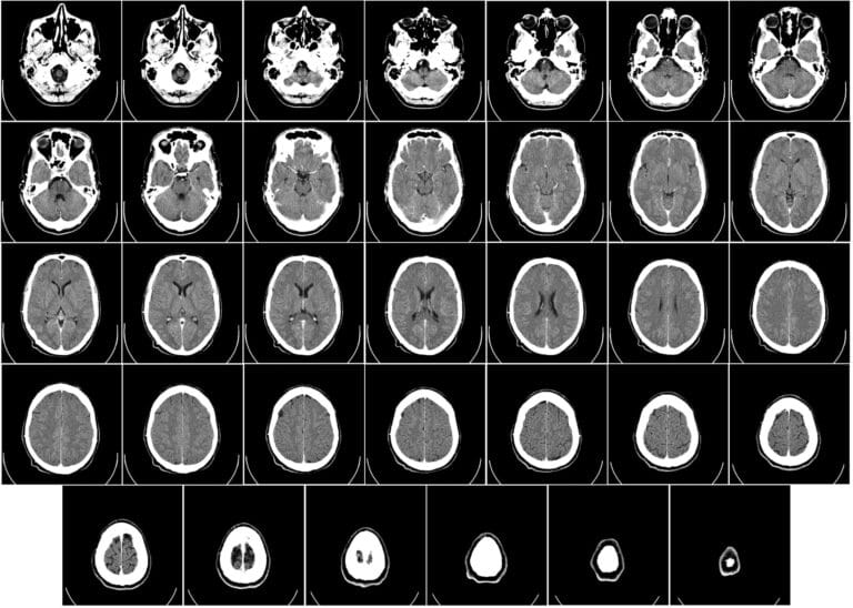 Computed tomography of human brain