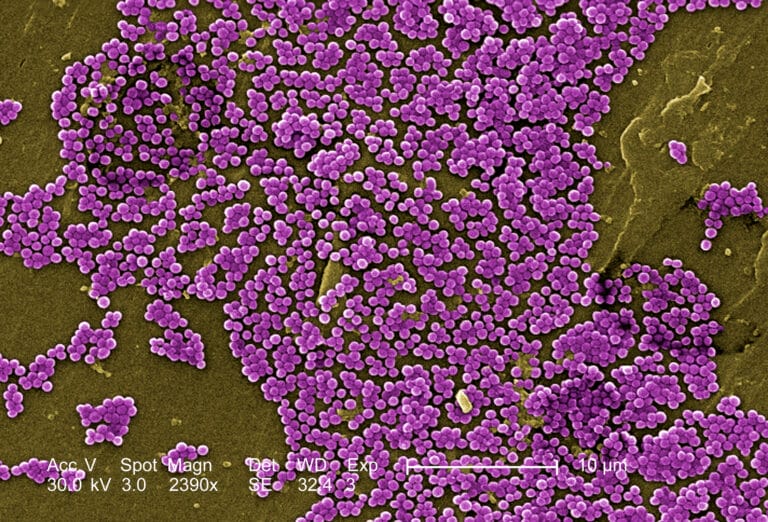 Methicillin resistant Staphylococcus aureus