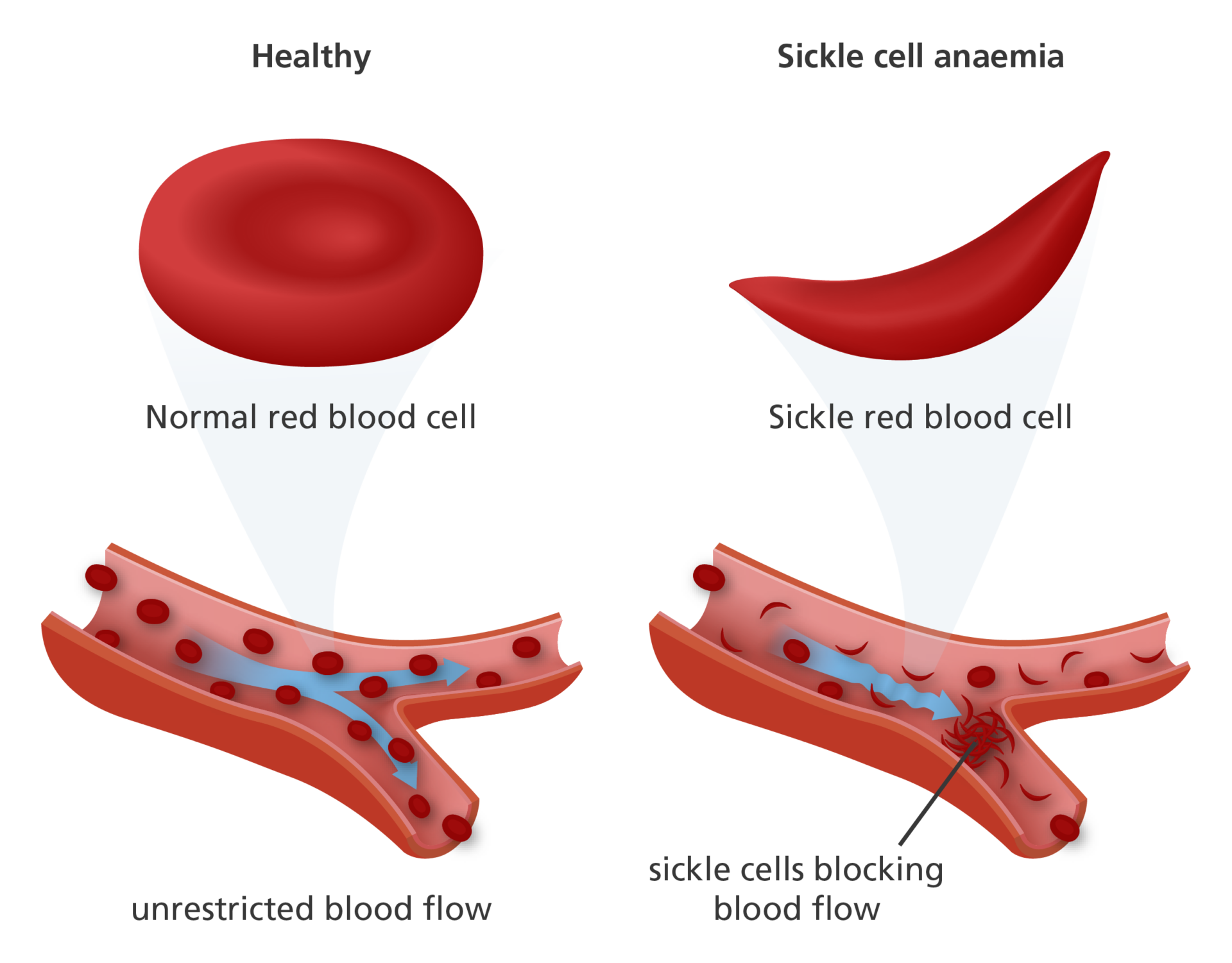 What is sickle cell anaemia?