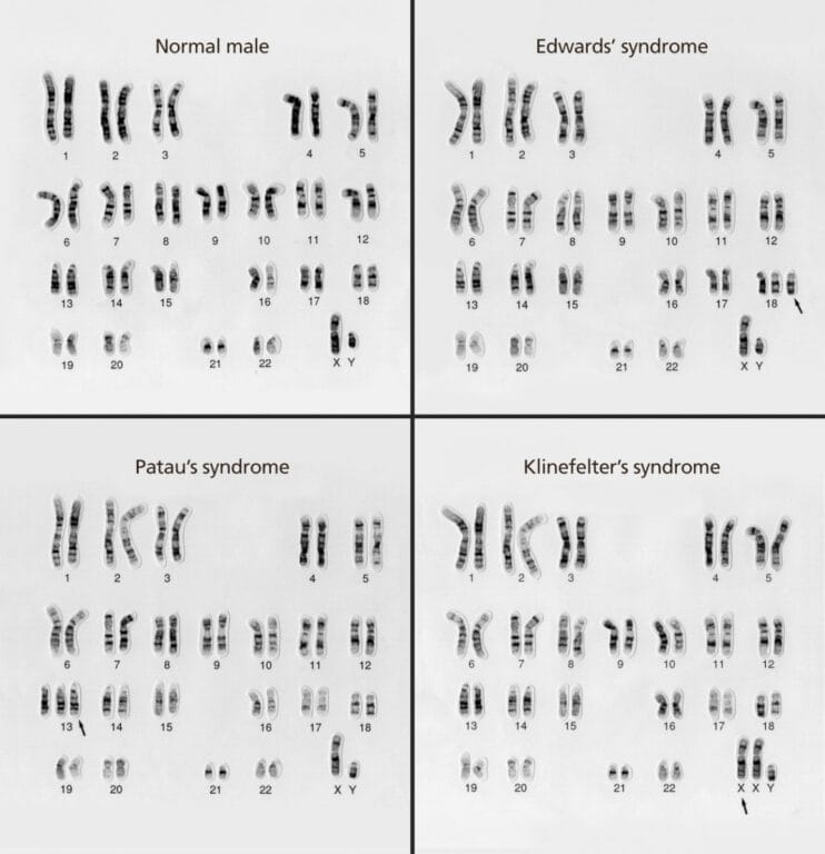 Karyotype Explanation Tool - Ring20 Research and Support UK CIO