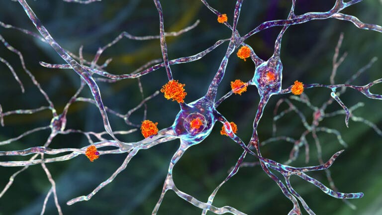 Neuronal,Inclusions,In,Huntington's,Disease,,3d,Illustration.,Inclusions,Are,Composed