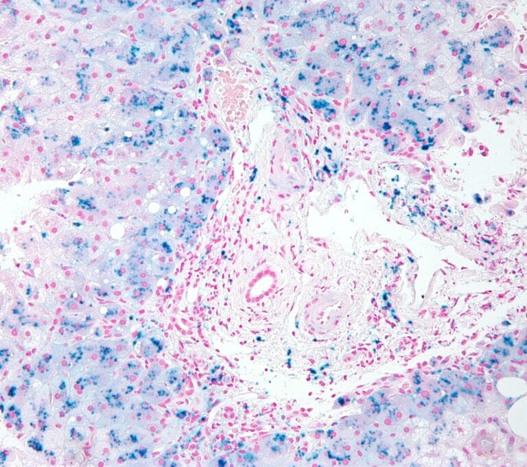 Hemosiderosis