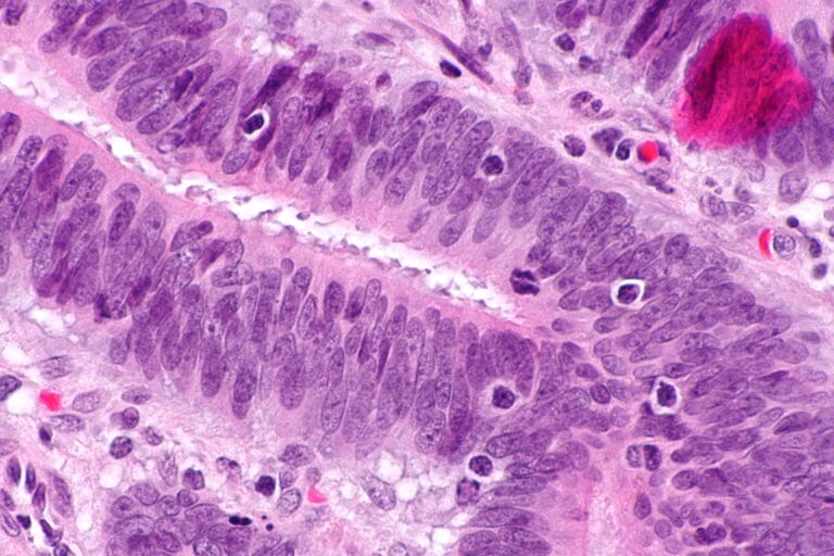 Tumour-infiltrating_lymphocytes