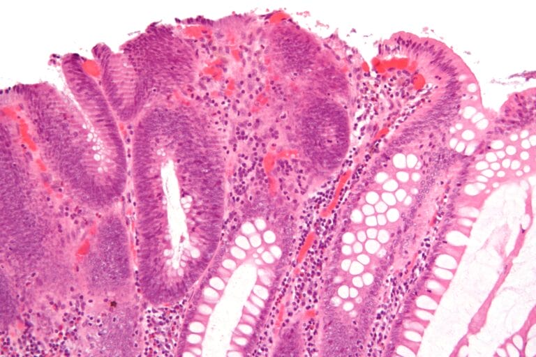 Tubular adenoma