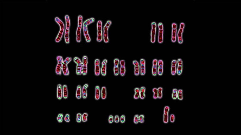 extra copy of chromosome 21