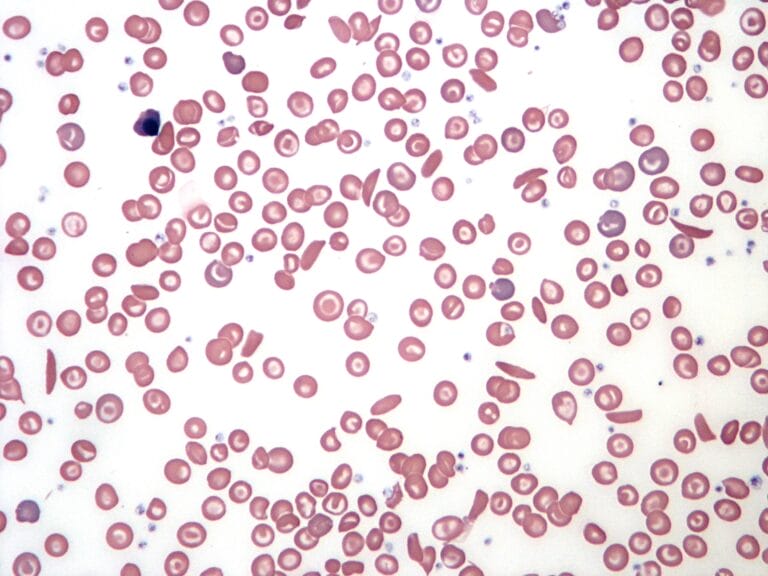 Sickle_Cell_Blood_Smear