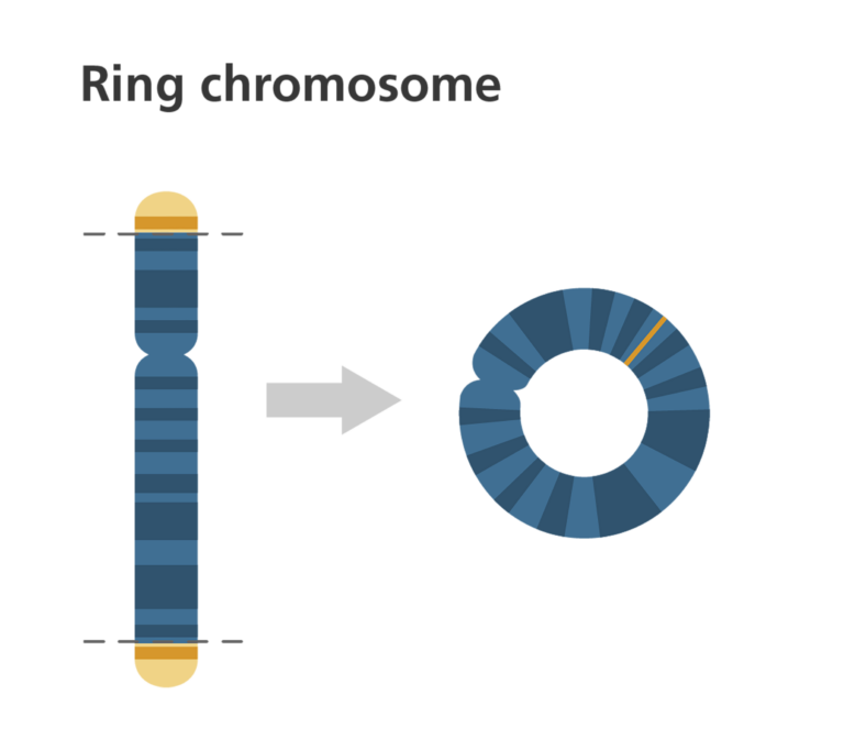 Ring chromosome 14 syndrome - Wikipedia