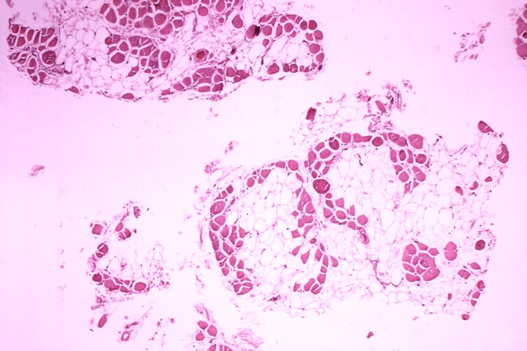 Microscope image showing a cross section of muscular dystrophy affected leg muscle, showing extensive replacement of muscle fibres (pink) with adipose cells (white).
